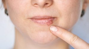 Kada herpes prestaje biti zarazan? Evo što treba znati - content image