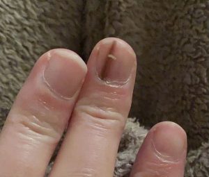 Elizabeta je primetila na noktu belu i crnu mrlju, otišla kod doktora i rekli joj da se udarila: Kad joj nije prošlo, vratila se i nastao je haos - content image