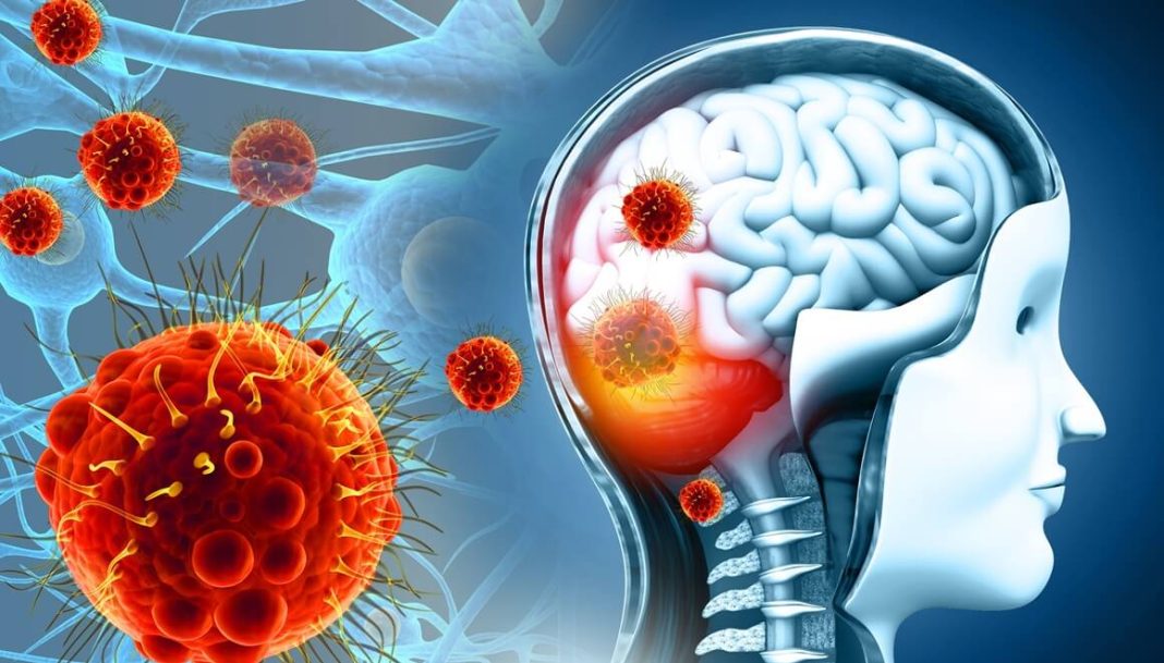 Koji su simptomi, kako se širi i kako se liječi meningitis B? - featured image