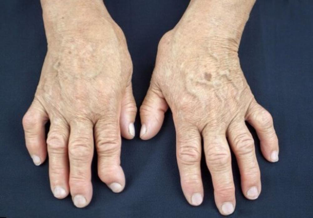 Jedan od glavnih uzroka reume nalazi se u ovoj namirnici: Sadrži opasnu bakteriju koja ubrzava ovu bolest - featured image Jedan od glavnih uzroka reume nalazi se u ovoj namirnici: Sadrži opasnu bakteriju koja ubrzava ovu bolest - featured image